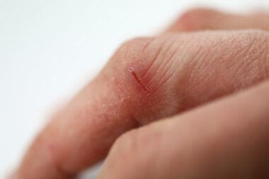 Skin Cracked